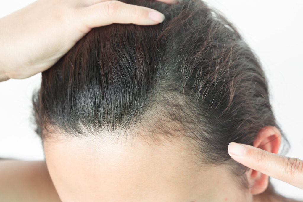 קלוז אפ על ראש של אישה שמצביה על שיער שצמח - הצמחת שיער