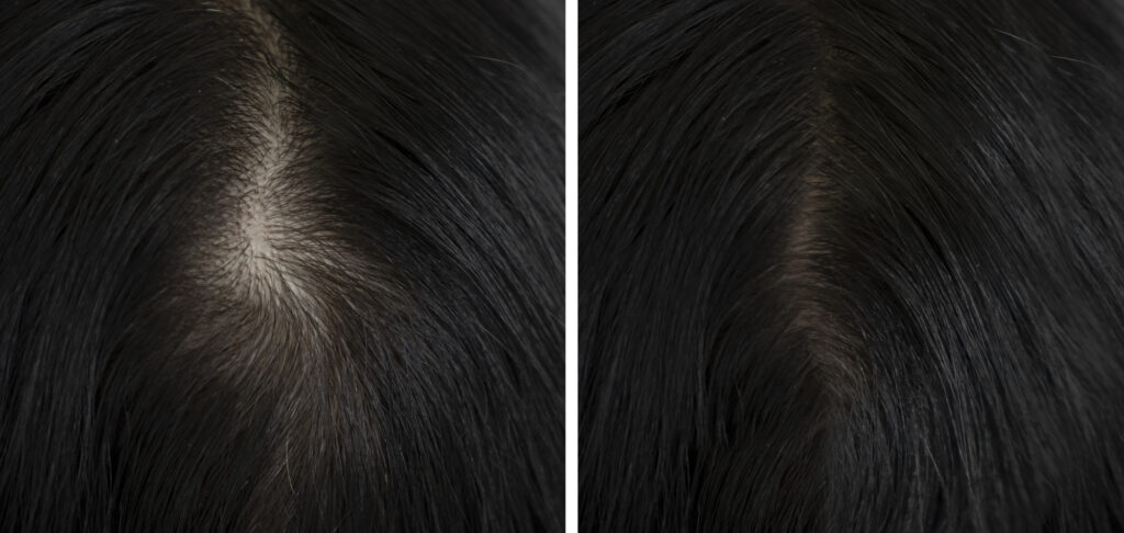 ראש של אישה לפני ואחרי נשירת שיער